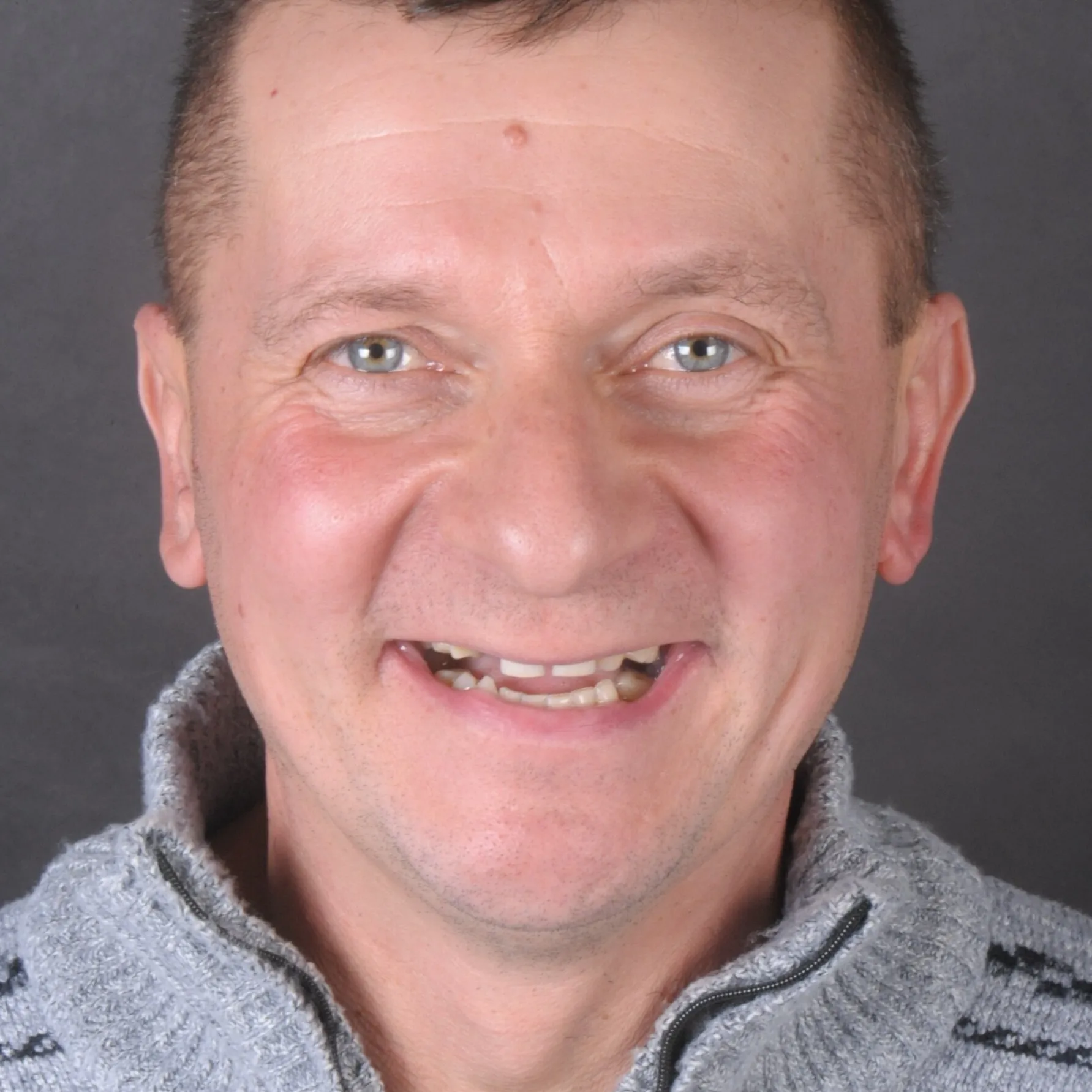 Rekonstrukcja pełnego łuku zębowego na implantach, efekt leczenia