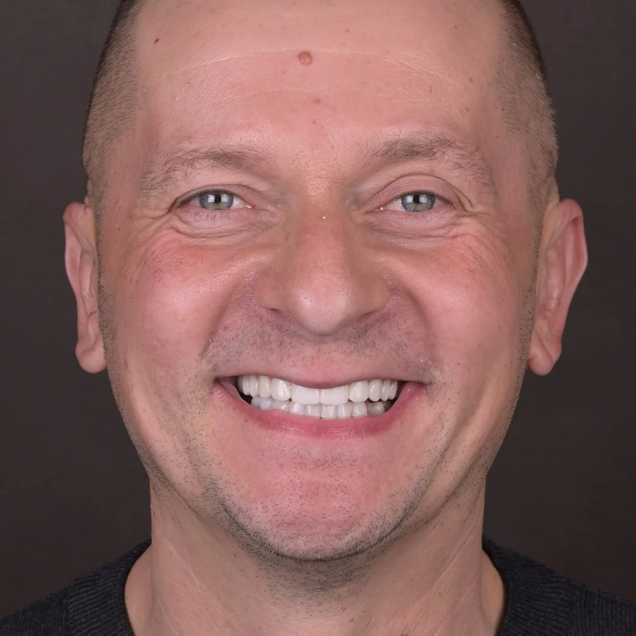Naturalny uśmiech po odbudowie na implantach w EndoEstetica Clinic