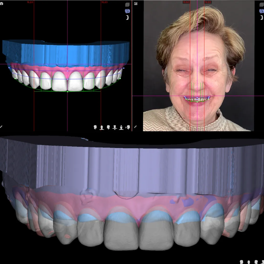 Most bioniczny na implantach, projekt uśmiechu