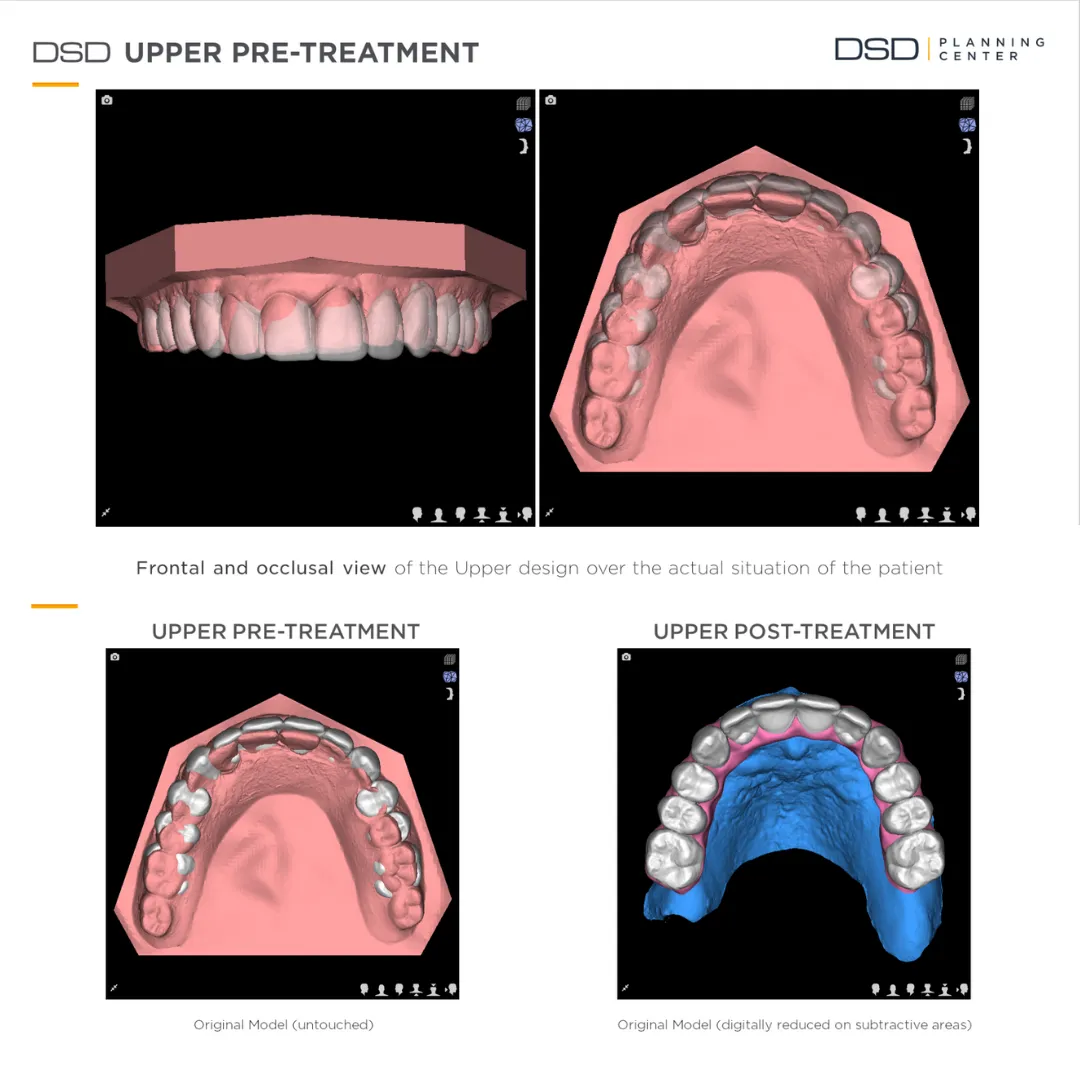 Efekt terapii Trzecie Zęby Time For Implants™