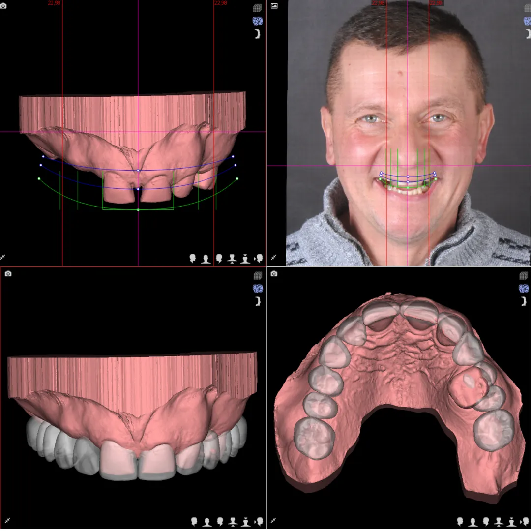 Etap leczenia Time For Implants™, rekonstrukcja bioniczna