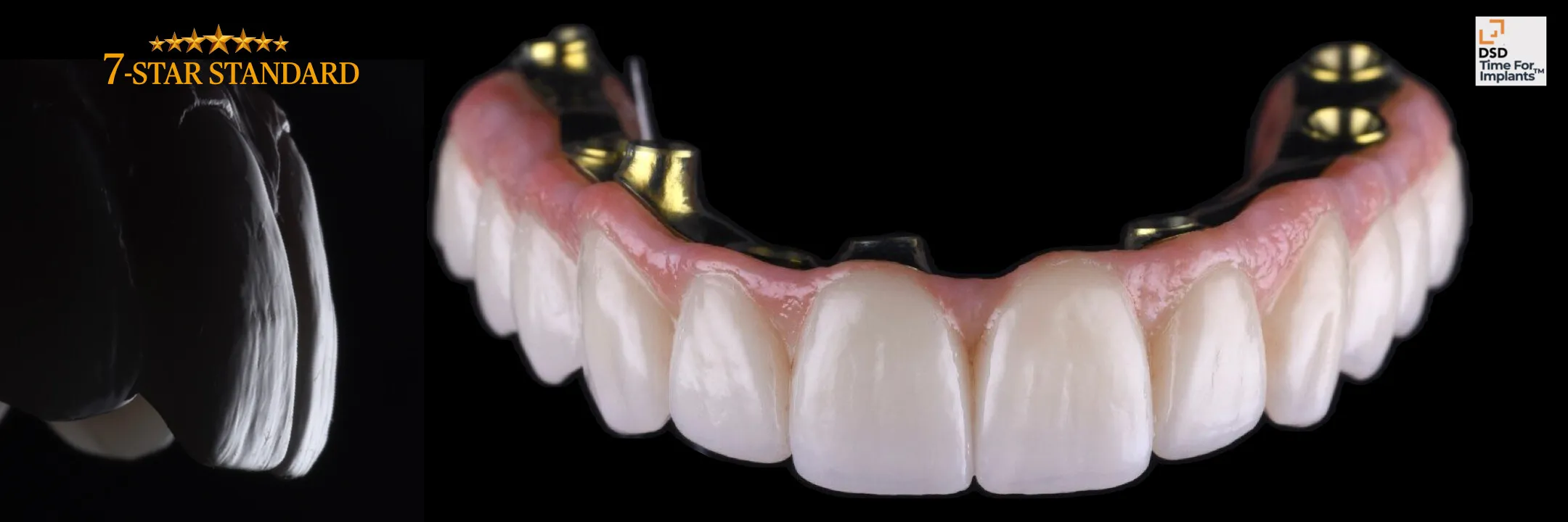 Most bioniczny 7 STAR na implantach, rekonstrukcja Time For Implants™