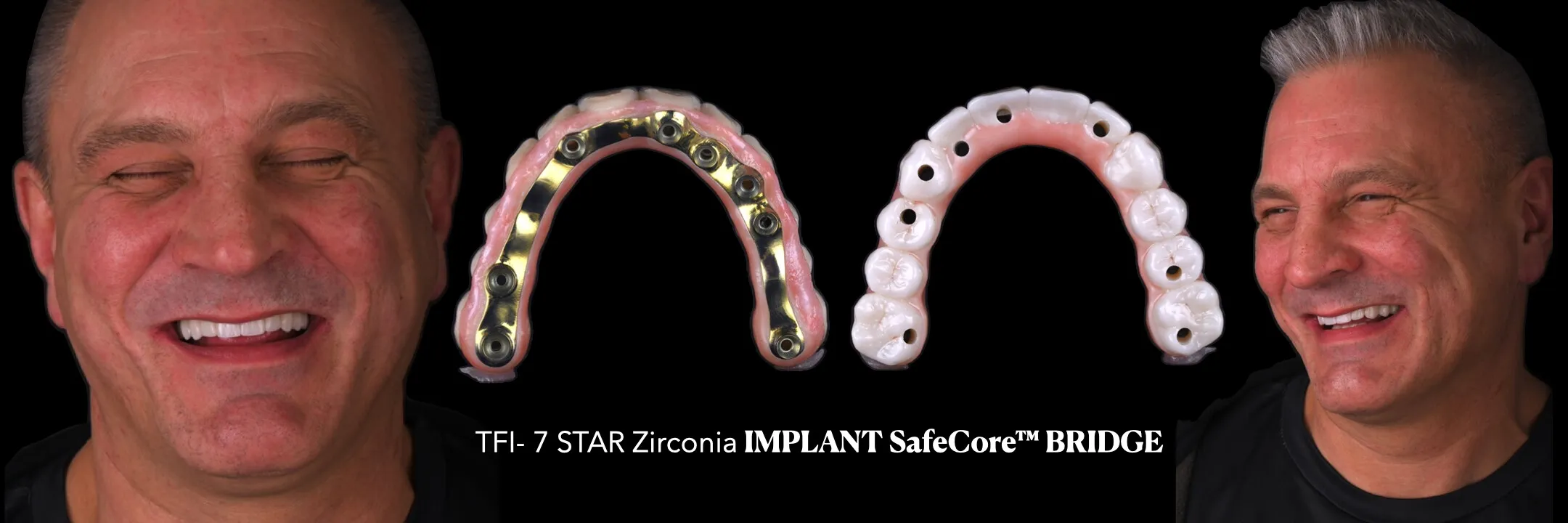 Konstrukcja mostu bionicznego wzmacnianego belką SafeCore na implantach