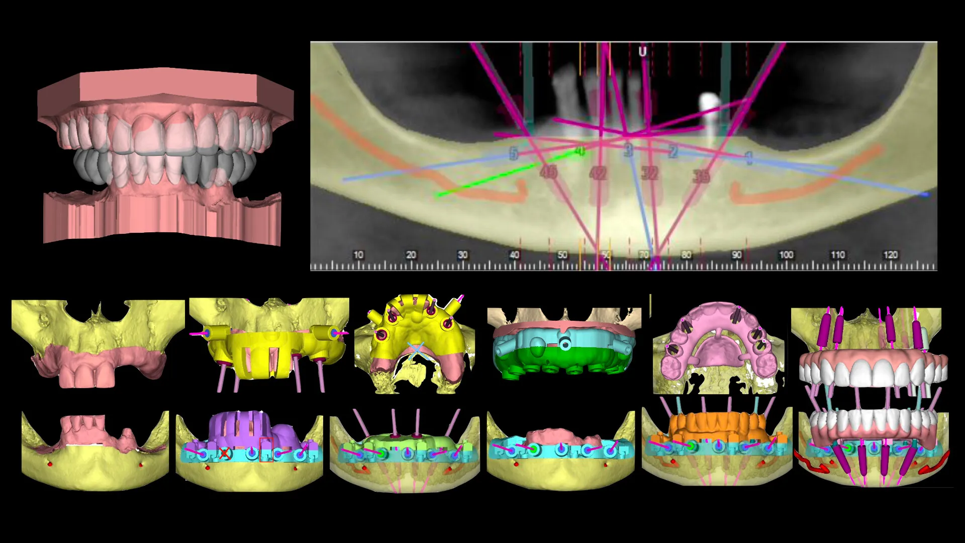Schemat przebiegu leczenia Time For Implants™, workflow rekonstrukcji bionicznej