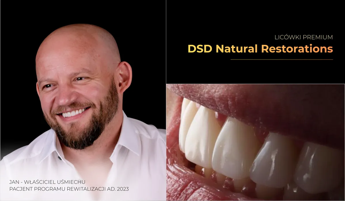 Naturalny uśmiech odtworzony w technologii DSD Natural Restorations