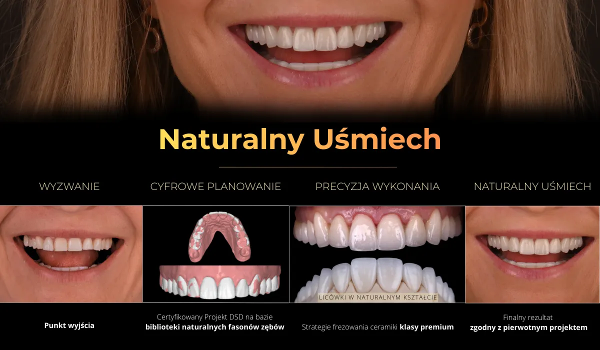 Naturalny uśmiech odbudowany metodą DSD Flow Injection, bez szlifowania zębów