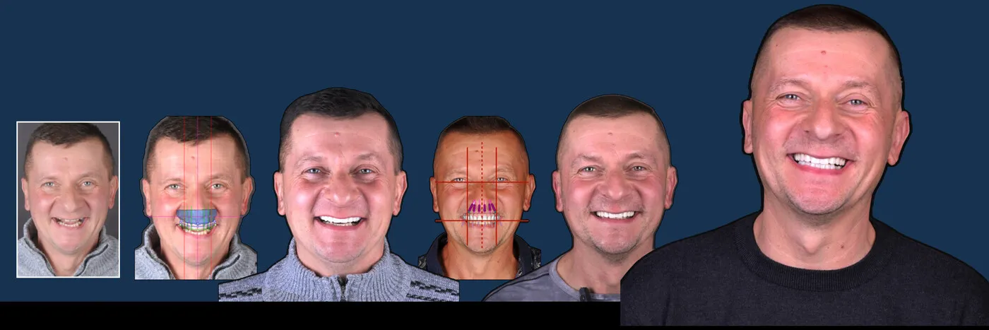 Pan Mirosław, uśmiech po leczeniu w EndoEstetica Clinic